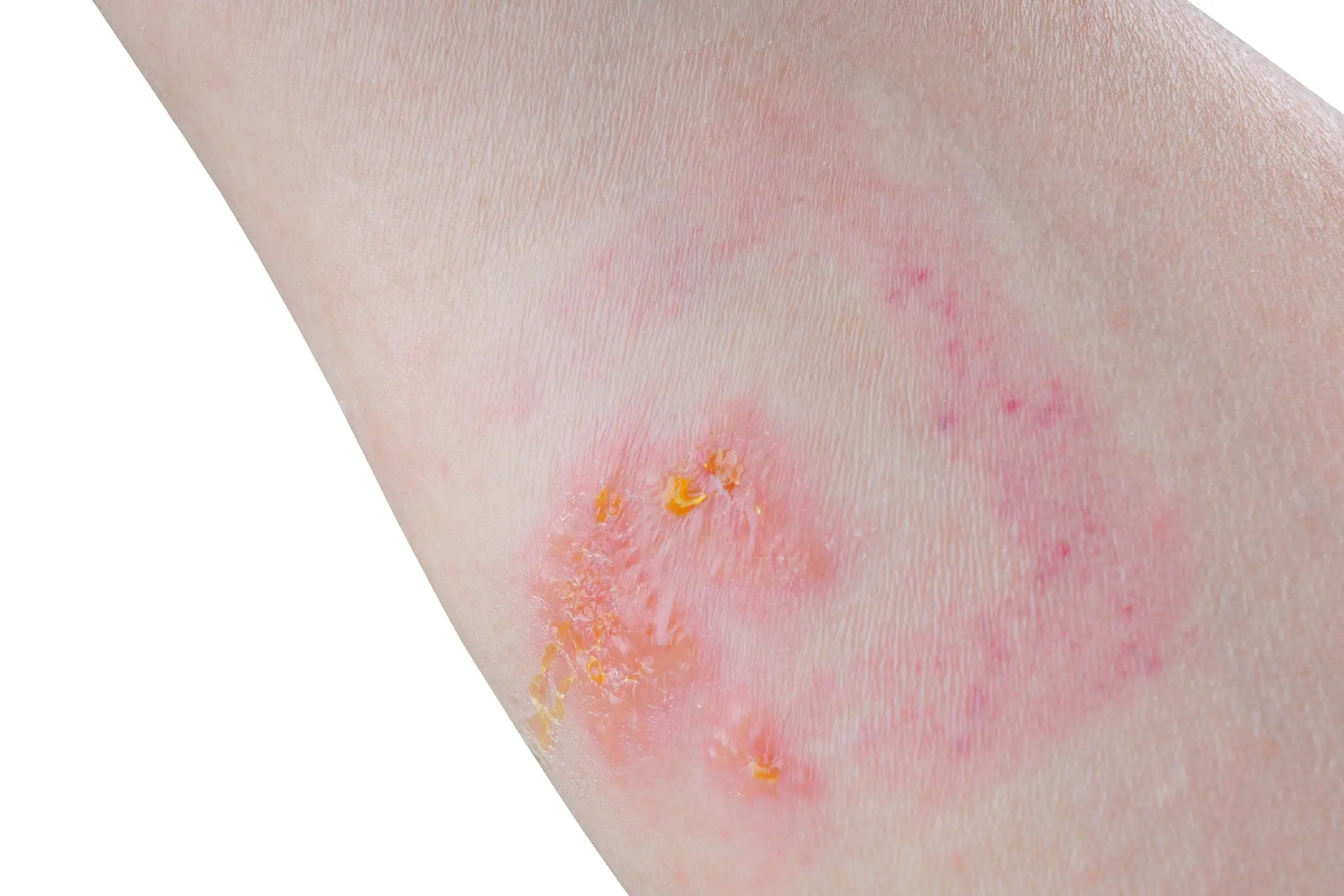 A person infected by Poison ivy and subsequently suffering from an uncomfortable rash