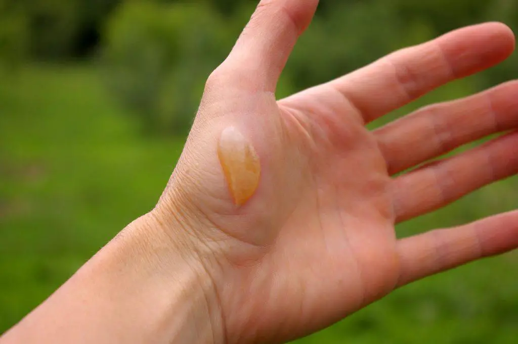 Burn on palm of hand from Giant Hogweed