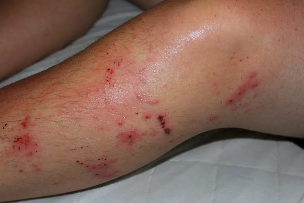 Poison ivy rash on a man s leg